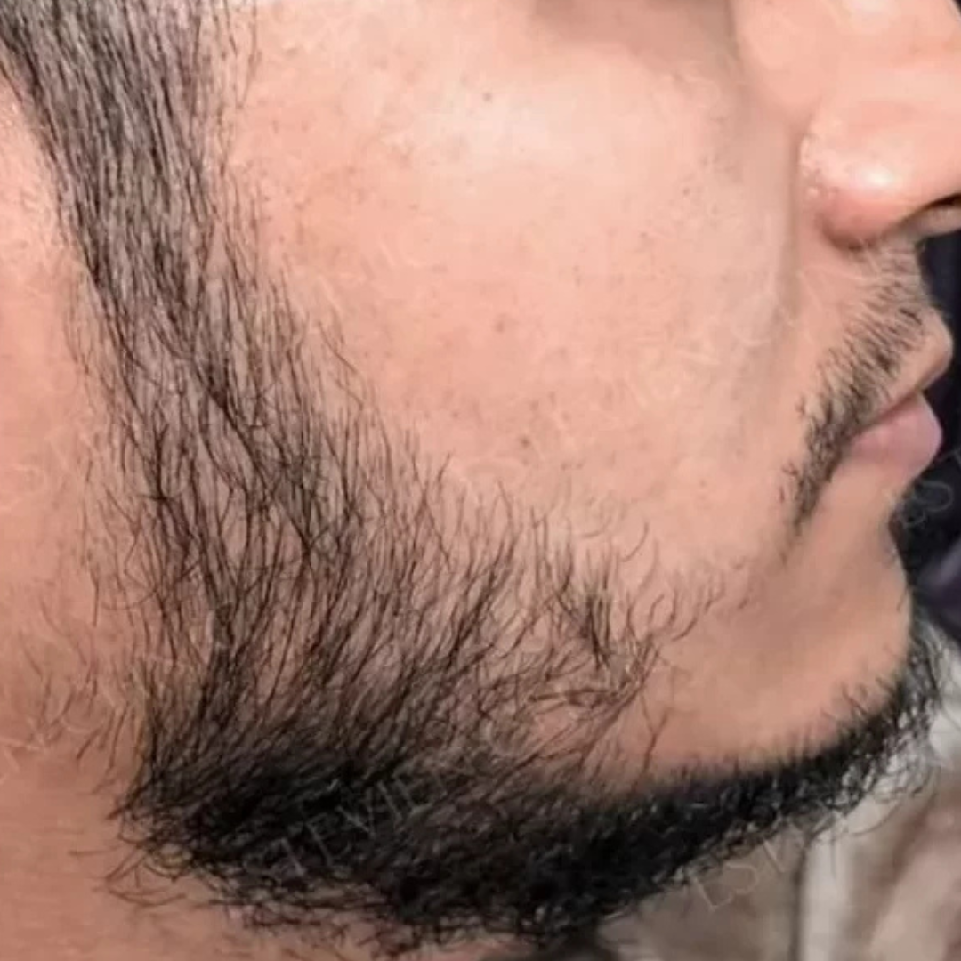 Before Beard Transplant