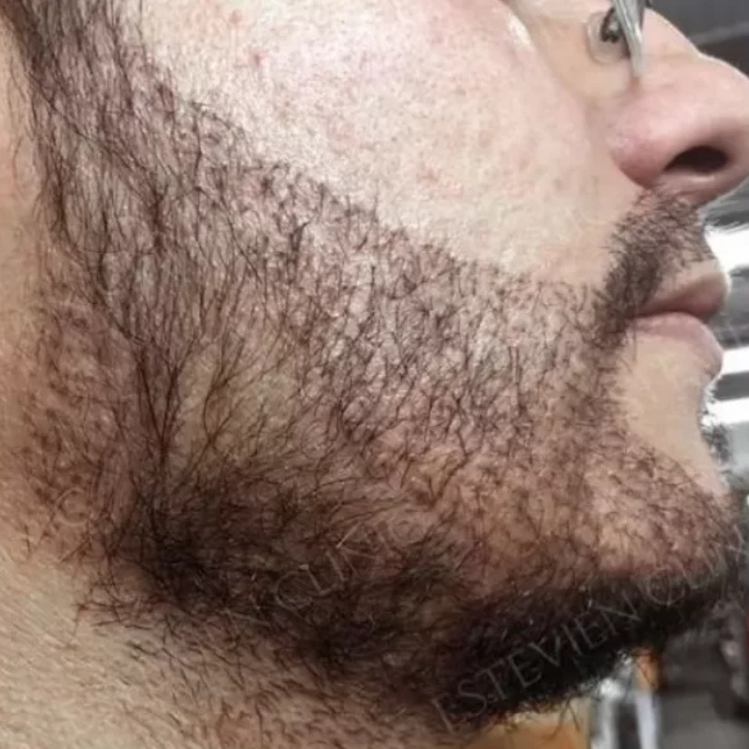 After Beard Transplant