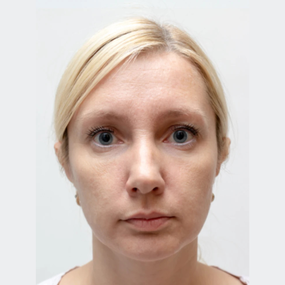 Before Botox Treatment