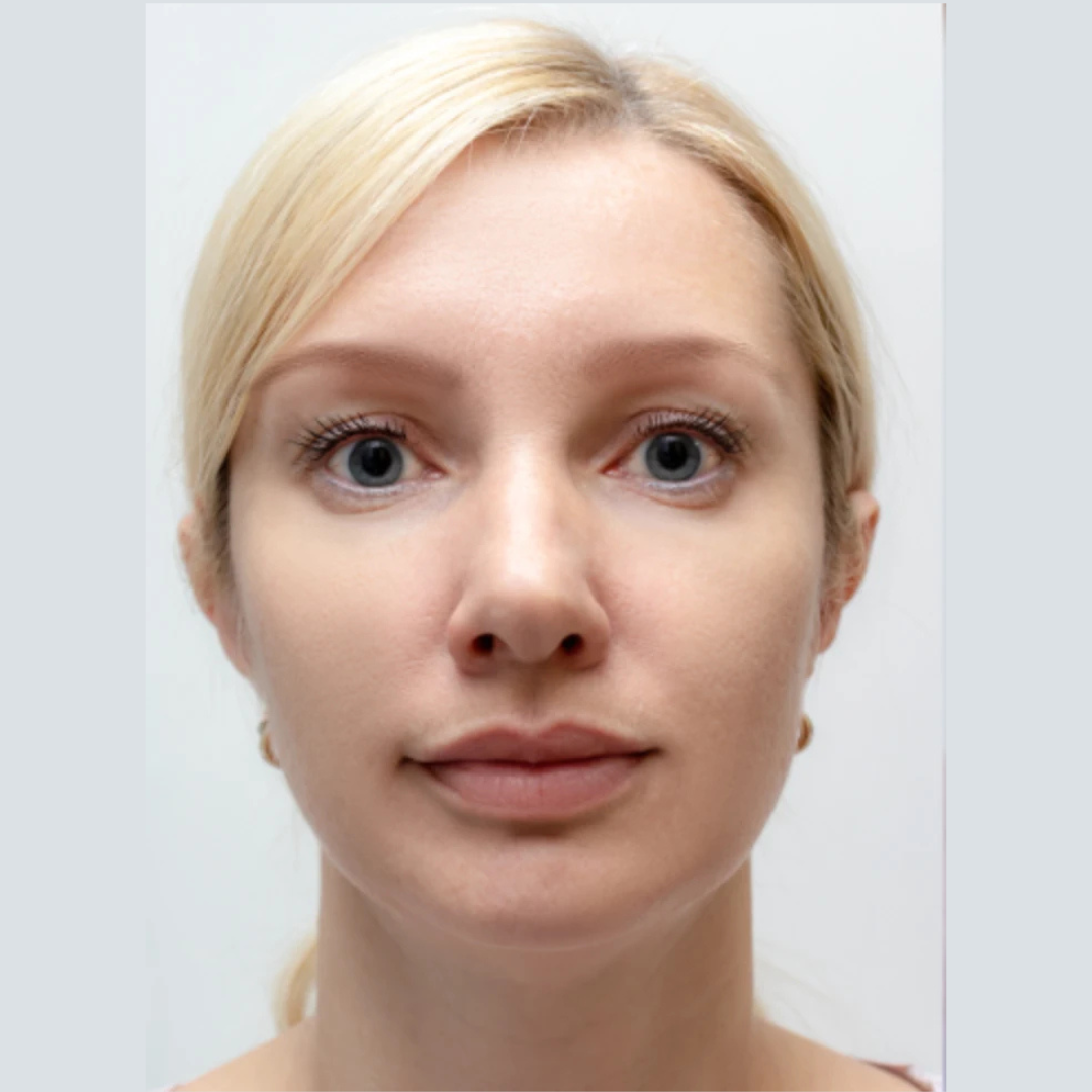 After Botox Treatment