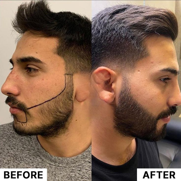Beard Transplant Delhi
