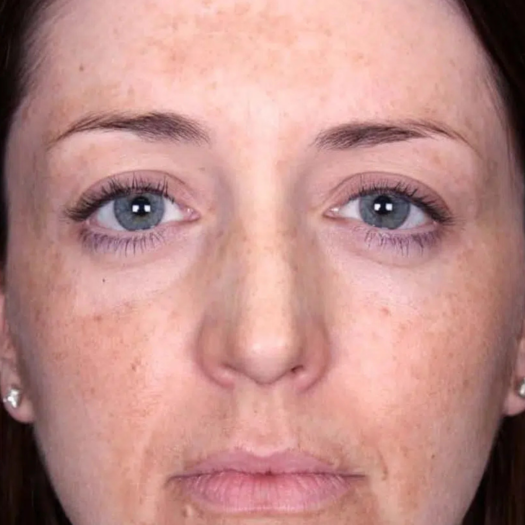 Before Chemical Peel