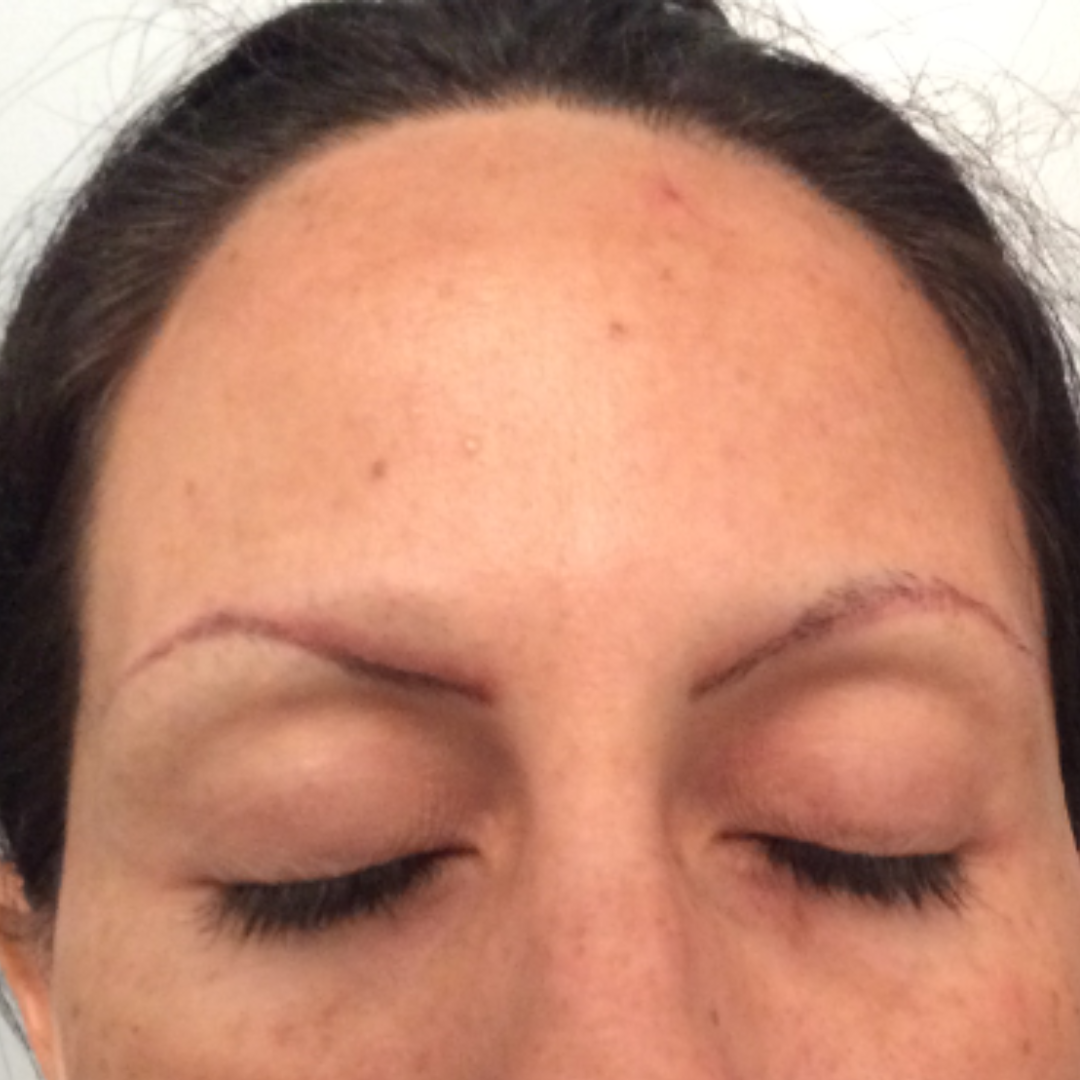 Before Eyebrow Transplant