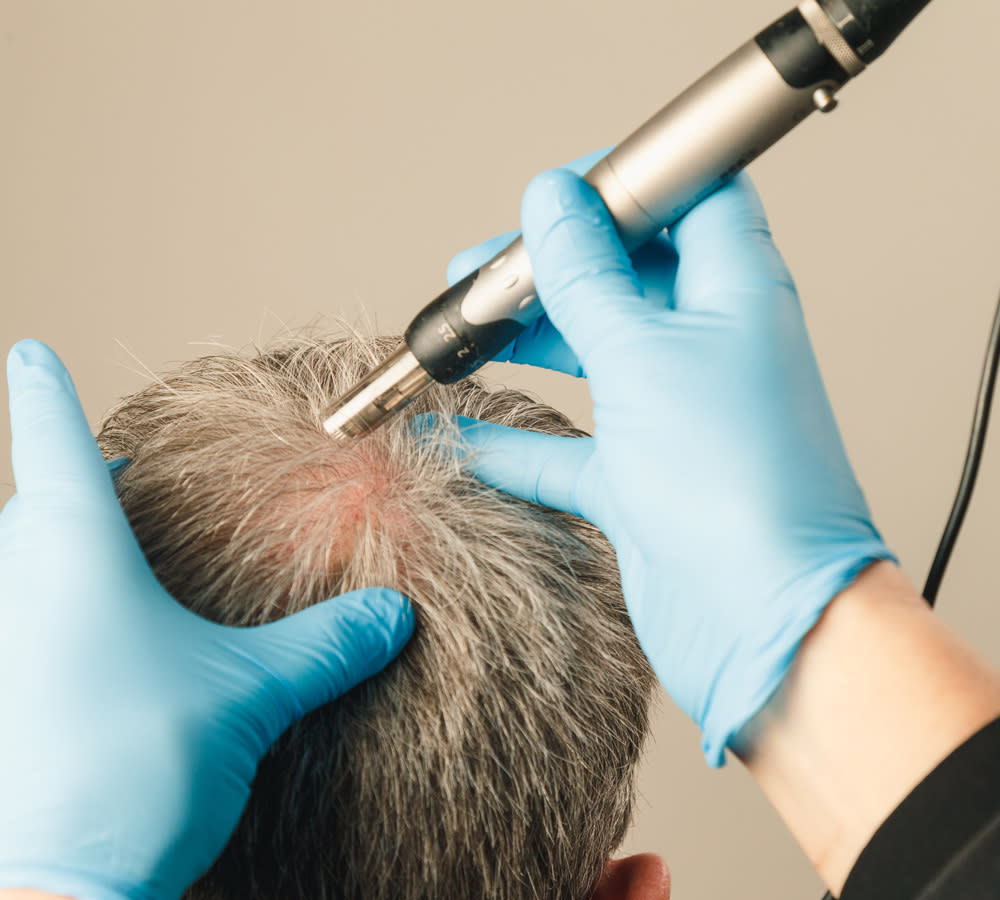 Hair Mesotherapy Process