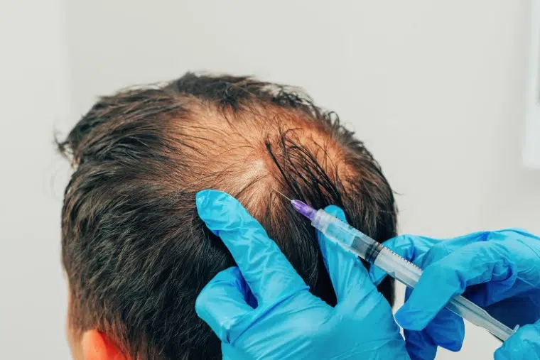 Hair PRP Treatment in Delhi