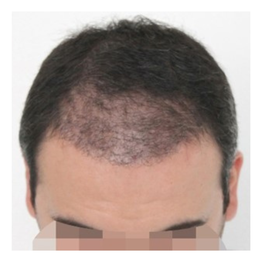 Before Hairline Transplant