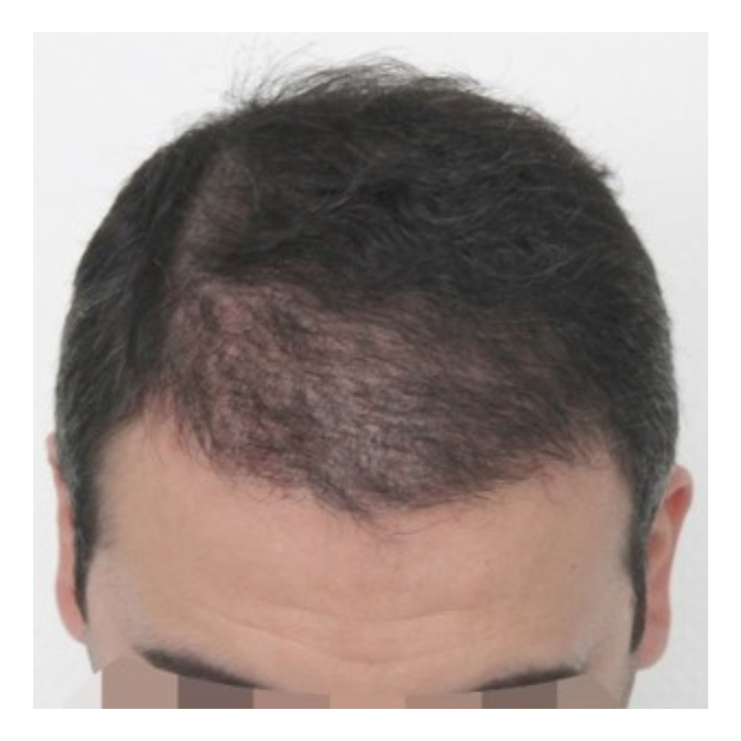 After Hairline Transplant
