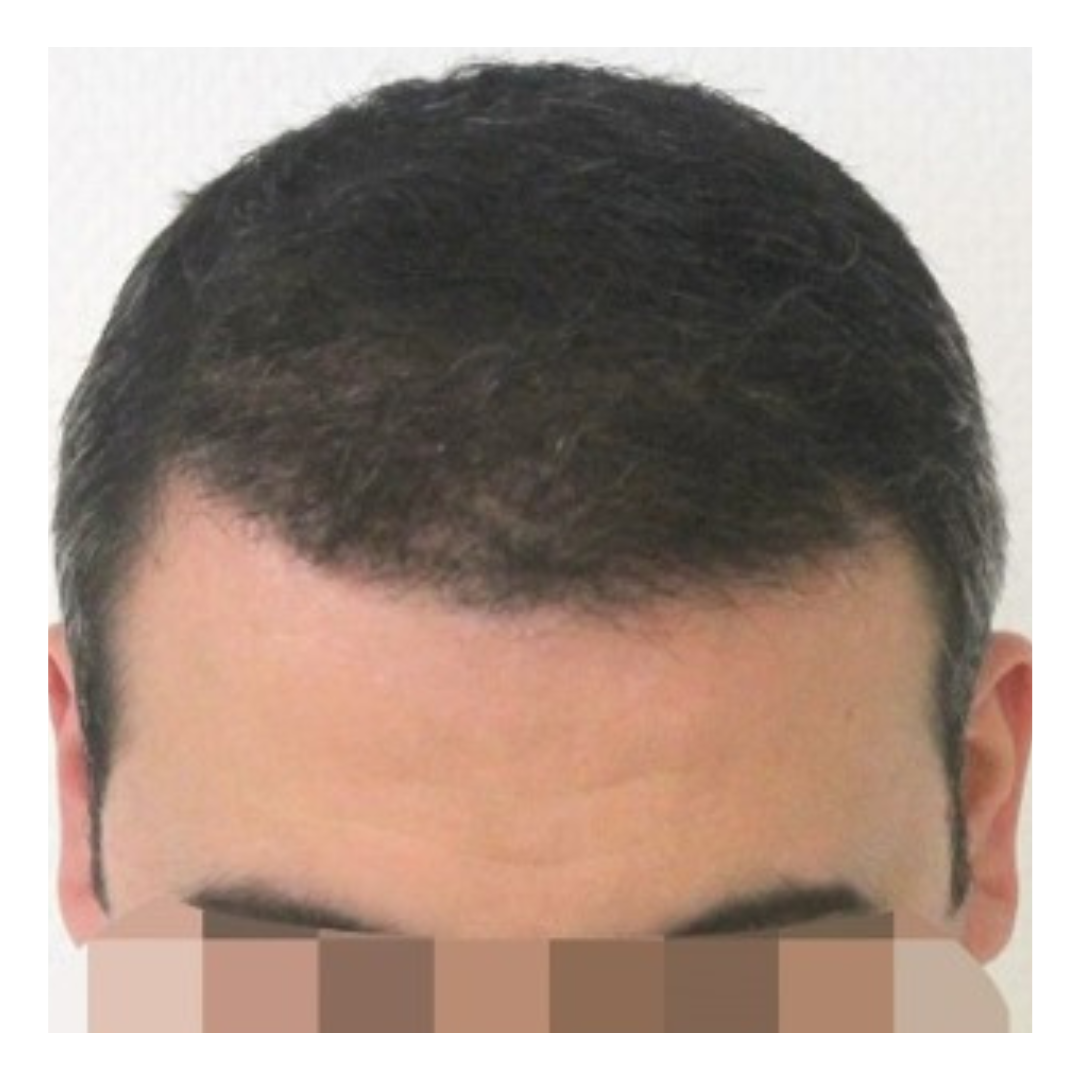 Hairline Results