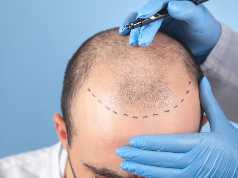 Hairline Transplant Benefits