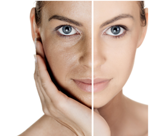 Laser Resurfacing Benefits