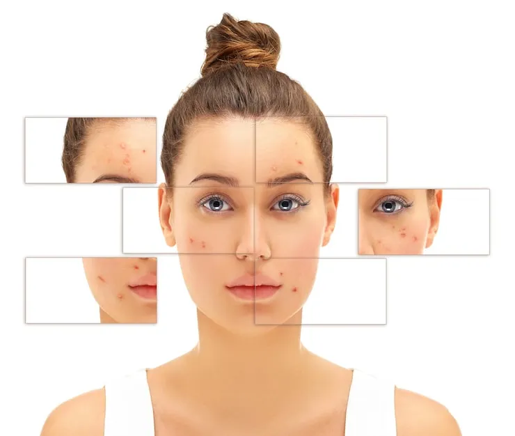 Pigmentation Treatment in Delhi